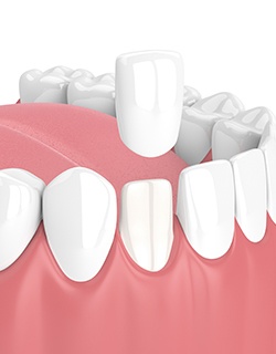 veneer over tooth