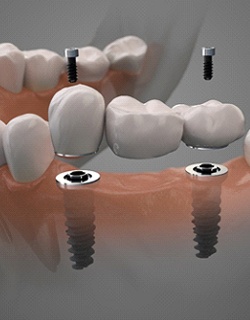 Dental implant dental bridge in Mount Pleasant