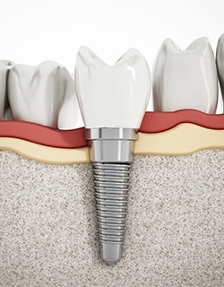 implant in bone