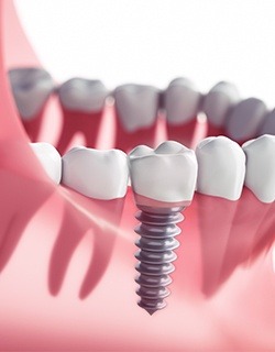 screwed in implant