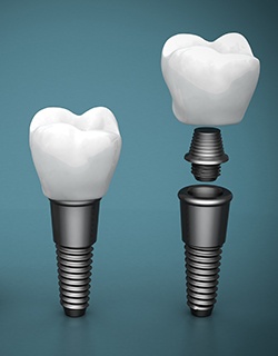 implant example