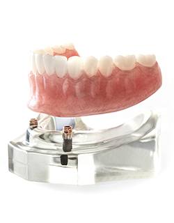 complete bottom denture