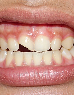 The cost of treating dental emergencies is different depending on the type of emergency