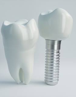 model of implant-retained crown next to model of natural tooth