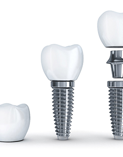 A digital image showing the various parts of a dental implant in Mount Pleasant