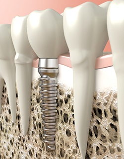 diagram of single dental implant in Mt Pleasant