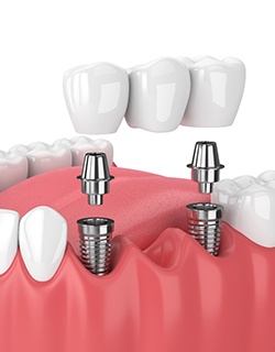 implant bridge in Mt Pleasant