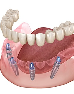 implant dentures in Mt Pleasant
