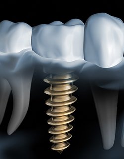 X-ray of a patient with a dental implant