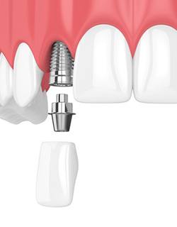 dental implant being placed in the upper arch 