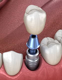 dental implant being placed in the lower jaw
