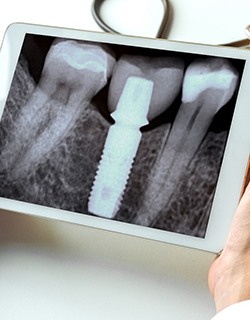 X-ray of a dental implant patient on a tablet