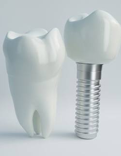 dental implant with crown next to real tooth