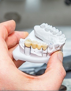 dental bridge on prosthetic