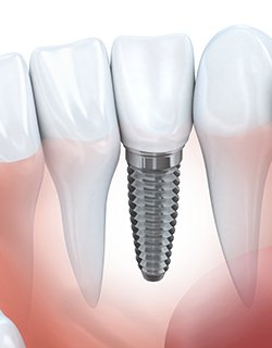 implant between teeth