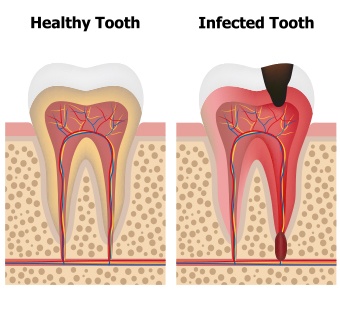 healthy vs infected tooth
