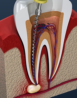 illustration of root canal process