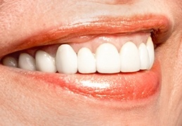 smile with detnal implants