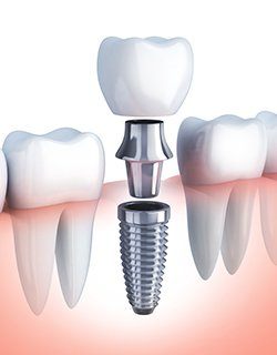 illustration of implant