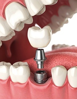 illustration of implant in mouth