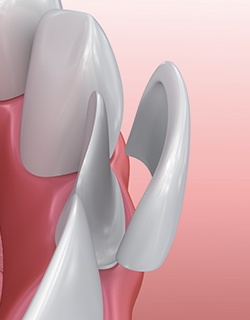 illustration of veneer