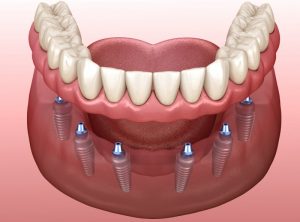 implant-retained dentures