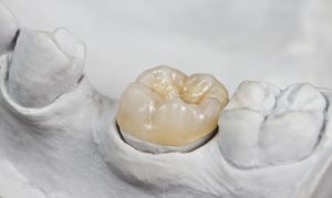 dental crown