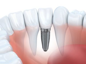 teeth dental implant