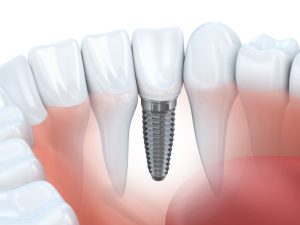 illustration of dental implant